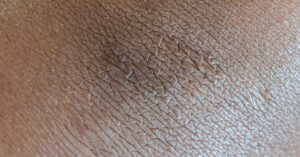 Lire la suite à propos de l’article Astuces naturelles pour lutter contre la peau sèche en 2025